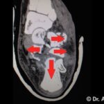 Ricostruzione Frattura