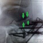 Ricostruzione Frattura del Calcagno