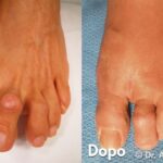 Alluce Valgo Bilaterale Prima e dopo l'intervento