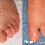 Alluce Valgo anni dopo l'intervento