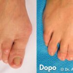 Intervento Alluce Valgo prima e dopo