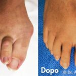 Alluce Valgo e dita a martello