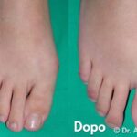 Intervento di Alluce Valgo giovanile