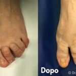 Intervento Alluce Valgo