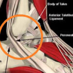 ricostruzione legamenti caviglia