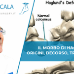 Morbo di Haglund Dottor Scala