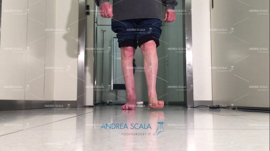 Protesi di Caviglia e paralisi uomo cammina senza stampelle
