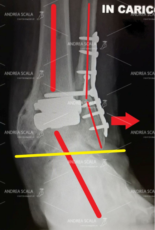 Luca Zimmer radiografia con protesi