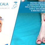 PROTESI DELLA CAVIGLIA. LA ANATOMIA NORMALE SI BASA SULLA INTEGRITA’ DEI DUE MALLEOLI. CON IL TAGLIO DEL PERONE SI RISCHIA L’INSTABILITA’