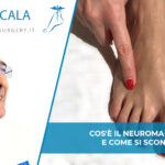 neuroma di Morton