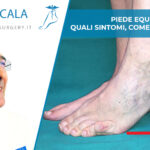 piede equino