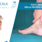 benefici della protesi di caviglia