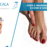 Cos'è il Neuroma di Morton