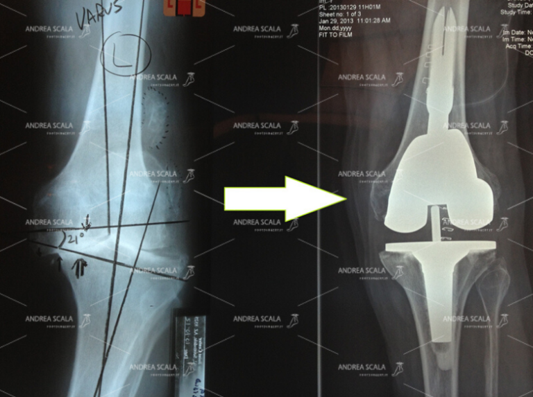 RX di ginocchio varo e RX del risultato ottenuto con la protesi di ginocchio