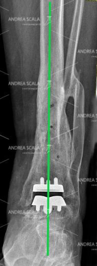 Rxgrafia post operatoria di una protesi della caviglia
