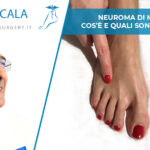 Neuroma di Morton: cos’è e quali sono le cause