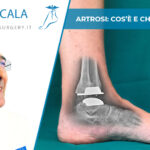 Artrosi: cos’è e chi può colpire