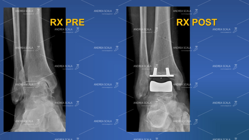 radiografie anteriore pre e post operatoria della caviglia.