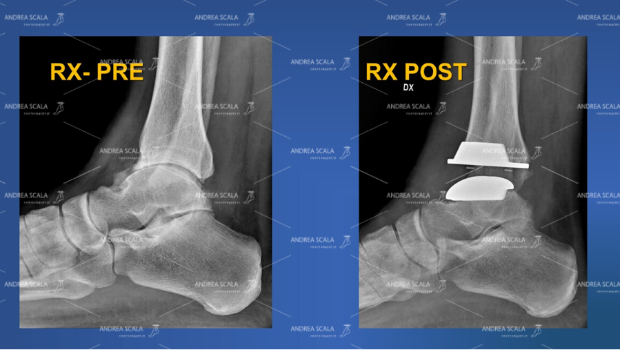 radiografie laterale pre e post operatoria della caviglia.