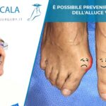 E' possibile prevenire l'insorgere dell'alluce valgo?