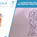 FRATTURA DEL CALCAGNO