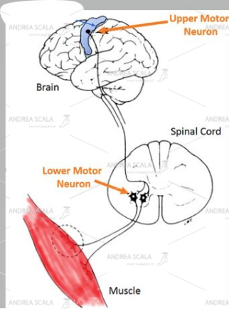 Lo schema mostra che l’origine del movimento muscolare normale e coordinato nasce dalla cellula nervosa collocata nella corteccia cerebrale. L’impulso elettrico si trasmette al 2° motoneurone collocato nel midollo spinale. L’impulso elettrico arriva alla placca neuro muscolare che contrae il muscolo. L’azione coordinata dei muscoli agonisti ed antagonisti permette i normali movimenti degli arti.