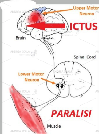 Lo schema mostra che a seguito dell’ictus cerebrale si interrompe la comunicazione con il neurone collocato nel midollo spinale. Il motoneurone periferico privo di controllo scarica impulsi non coordinati ai muscoli degli arti (paralisi flaccida e paralisi spastica). Dal disordine degli impulsi elettrici midollari deriva la deformità degli arti tipica dell’ictus.