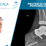 PROTESI DI CAVIGLIA PERSONALIZZATA