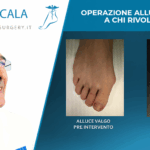 Operazione alluce valgo