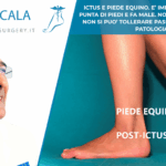 ictus e piede equino