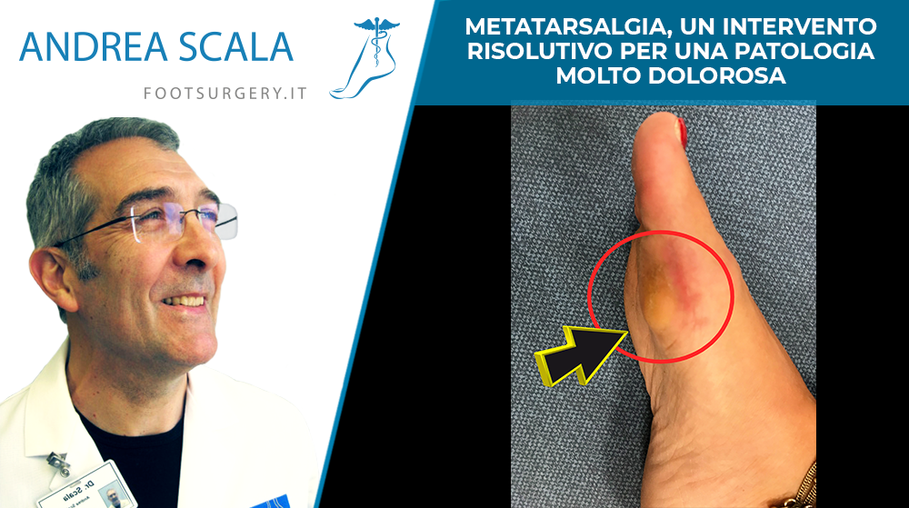 Metatarsalgia un intervento risolutivo per una patologia molto dolorosa