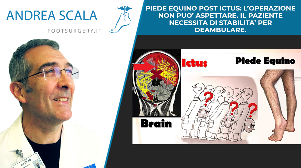 PIEDE EQUINO POST ICTUS: L’OPERAZIONE NON PUO’ ASPETTARE. IL PAZIENTE NECESSITA DI STABILITA’ PER DEAMBULARE.