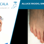 Alluce rigido sintomi e cura