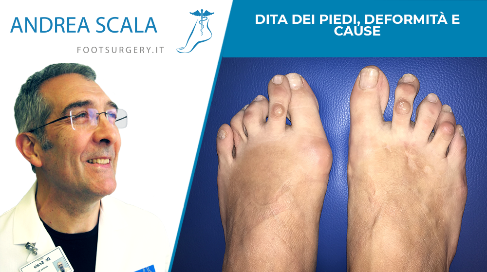 Dita dei piedi, deformità e cause -