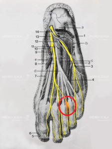 neuroma-di-morton-2.jpeg