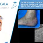 LA FRATTURA DI CALCAGNO DEVE ESSERE OPERATA CON PLACCA E VITI. CON I FILI DI K. RISULTATO E’ SCADENTE.