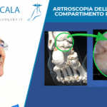 TENDINITE FLESSORE LUNGO DELL’ALLUCE