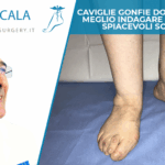 Caviglie gonfie dopo lo sport: meglio indagare per evitare spiacevoli sorprese