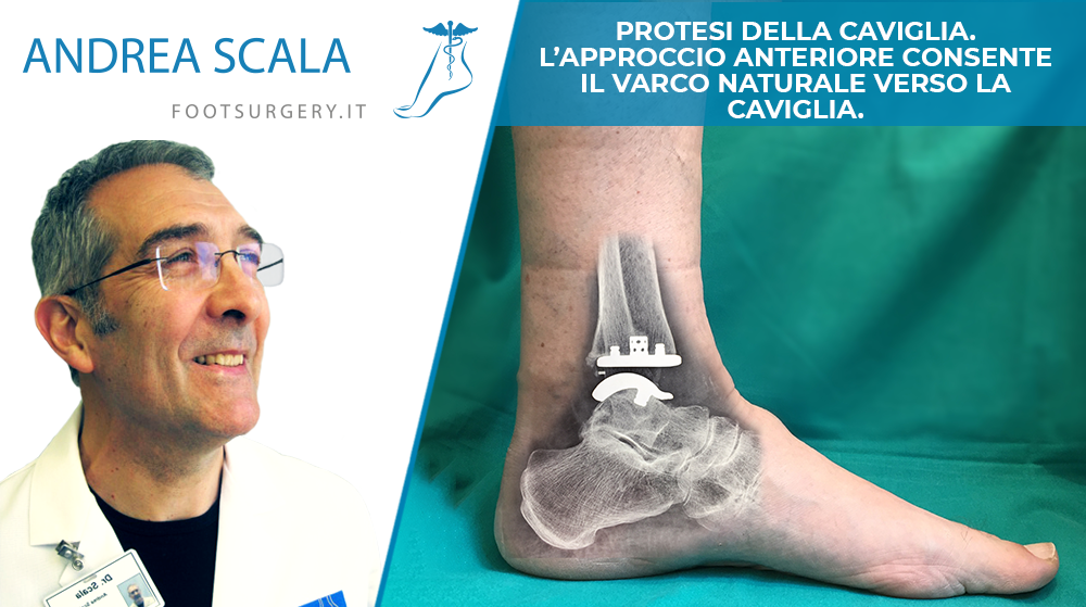 PROTESI DELLA CAVIGLIA. L’APPROCCIO ANTERIORE CONSENTE IL VARCO NATURALE VERSO LA CAVIGLIA.