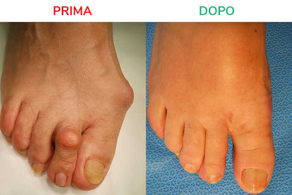 alluce-valgo-04